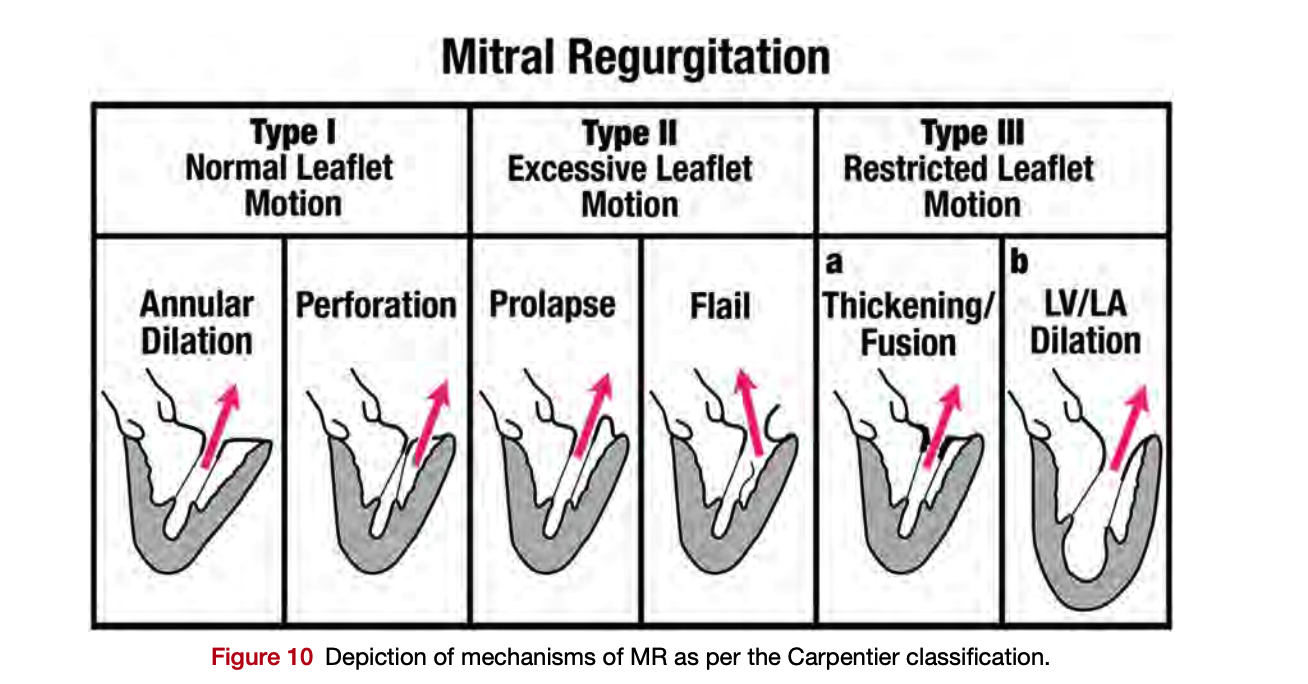 Classificação de Carpentier - Mecanismos de Regurgitação Mitral: Tipo I (Movimento Normal), Tipo II (Movimento Excessivo), Tipo III (Movimento Restrito)